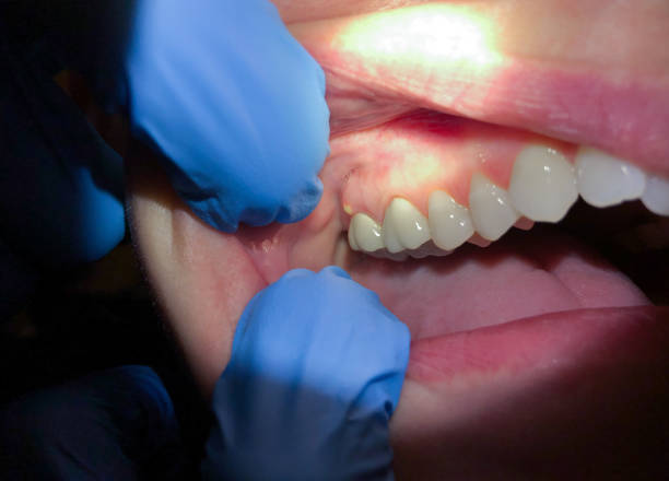 Best Emergency Tooth Extraction in Avilla, IN